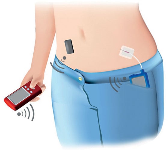 Koncept, který zbaví diabetiky velké části starostí.